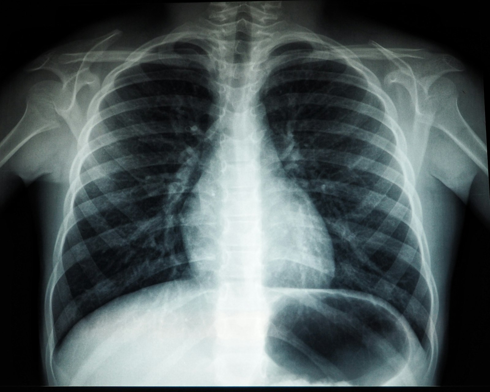 A black and white chest X-ray showing the rib cage, both lungs, the heart outline and the collarbones